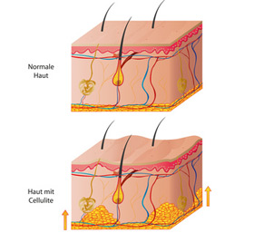 Cellulite bei männern am po